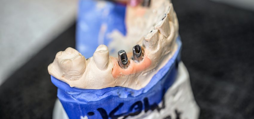 השתלת שיניים לפני ואחרי