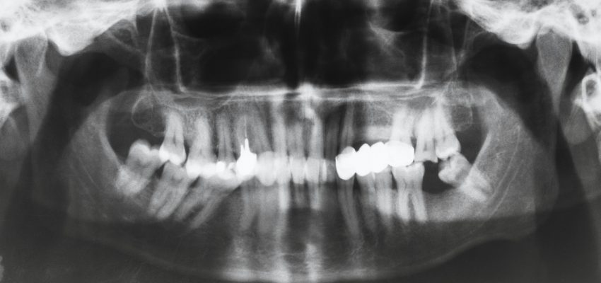 צילום שיניים פנורמי